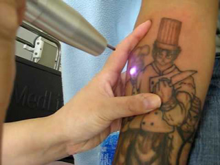 Tips for Taking Care of Your Skin After Tattoo Removal